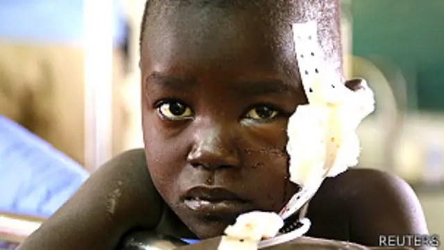 Niño herido tras los últimos enfrentamientos en Sudán del Sur