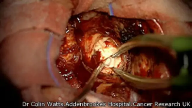 گلیوبلاستوما کشندهترین تومور مغز است