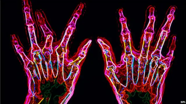 类风湿性关节炎