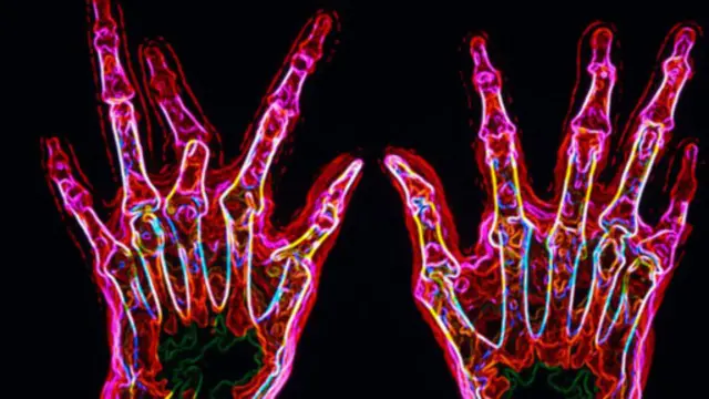 植入電子裝置來治療嚴重關節炎成為患者福音，一名女性已經被「奇蹟般」治癒。