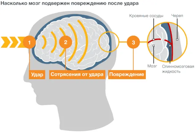 Мозг после удара