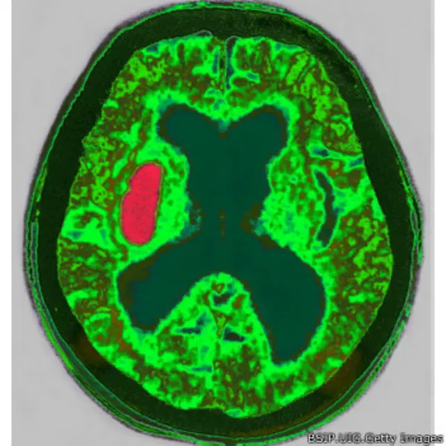 در صورت شک به ضربه یا خونریزی مغزی باید CT اسکن یا MRI انجام شود