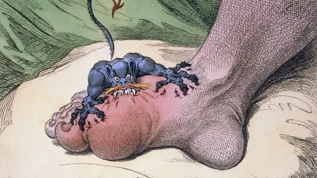 Ilustración de James Gillray (1799) sobre la gota.