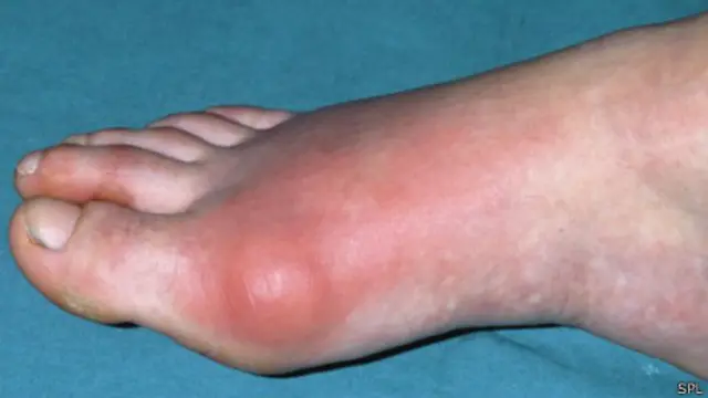 Articulación del dedo del pie con gota.
