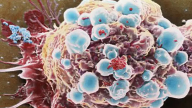 سلول سرطانی