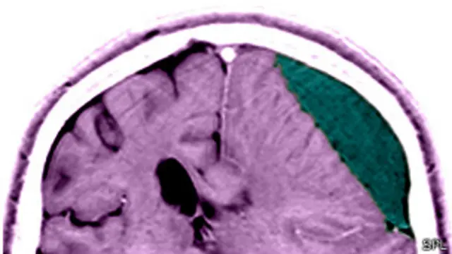 Escáner de un cerebro con una lesión cerebral.