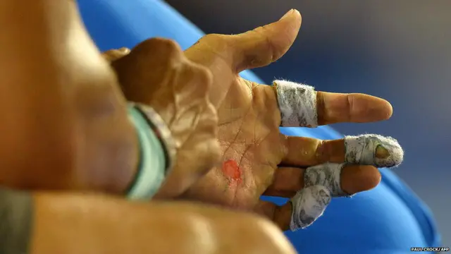 हाथ में बेहद कष्टकारी छालों के बावजूद रफ़ाएल नडाल ने ऑस्ट्रेलियाई ओपन के सेमी फ़ाइनल मुकाबले में 17 ग्रैंड स्लैम ख़िताबों के विजेता रोजर फ़ेडरर को हरा ही दिया. 