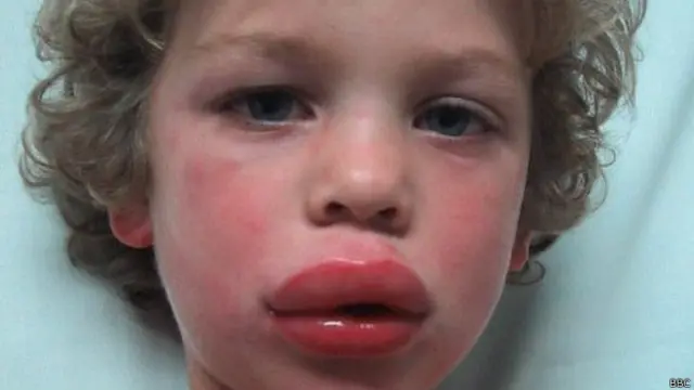 niño con el labio hinchado