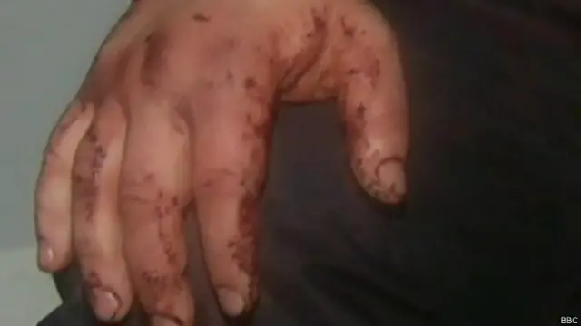 Mão de Dmytro Bulatov (Foto: BBC)