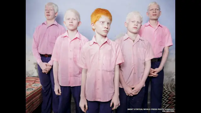 Слепые дети-альбиносы в Индии