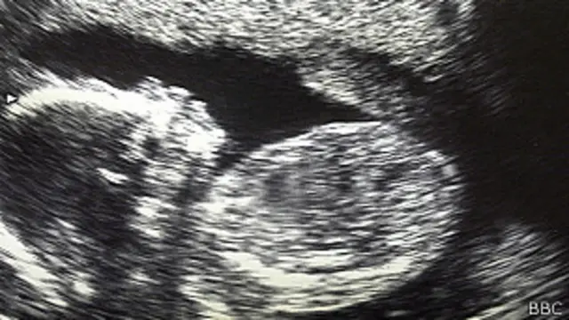 Ultrasonido de bebé