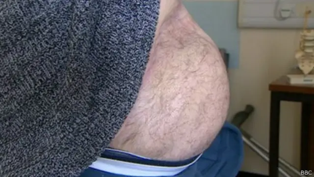 استخدم الجراحون أجزاء من جلد الذراع لإصلاح موضع العملية بعد توصيل الساق بالذراع لضمان استمرار تدفق الدم