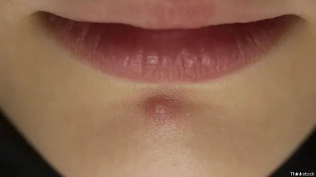 मुहांसे, महिला