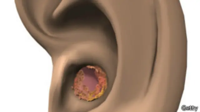 oreja con cera