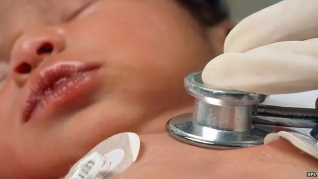 هاجم أطباء بريطانيون قواعد التبرع بالأعضاء، مشيرين إلى أنها تؤدي إلى وفاة الأطفال الرضع