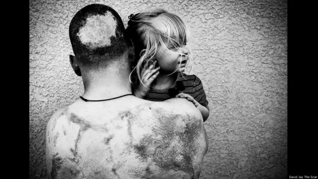 David Jay, proyecto fotográfico sobre cicatrices The Scar