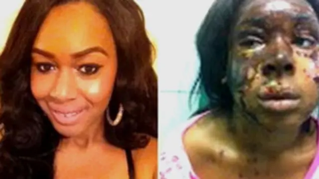 नाओमी ओनि, एसिड अटैक पीड़िता