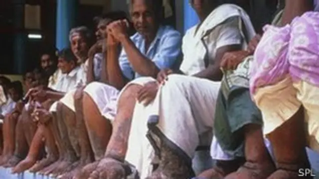 Elefantiasis en India.