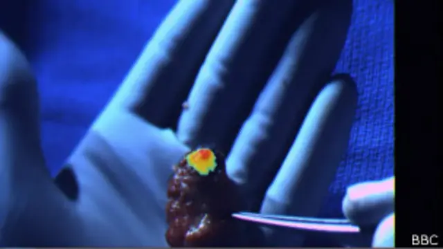 Células câncerígenas são detectadas pelo óculos e projetadas no campo de visão do cirurgião