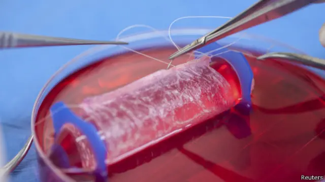 Implan vagina, Reuters