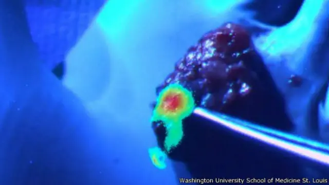 ترصد أدوات الاستشعار الموجودة في النظارة الجديدة الضوء المنبعث من الأنسجة السرطانية