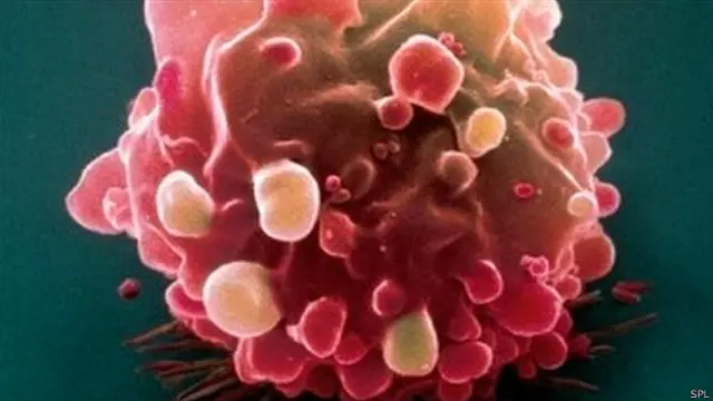 आंत का कैंसर