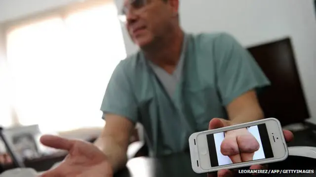 Doctor muestra los peligros de inyectarse silicona en las nalgas