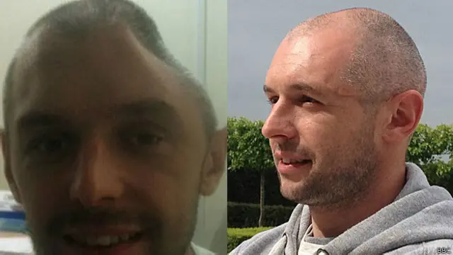 Lee Charie antes e depois do implante da prótese (BBC)