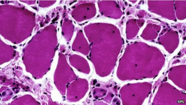 ڈی ایم ڈی ہر ساڑھے تین ہزار میں سے ایک بچے کو متاثر کرتا ہے