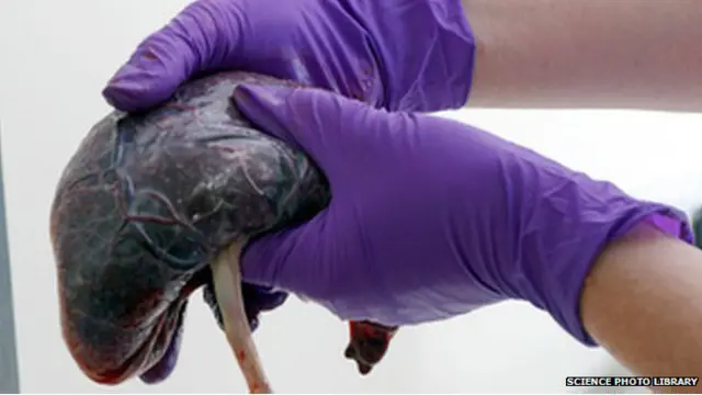 Klaim bahwa menyantap plasenta mengandung vitamin dan bermanfaat bagi kesehatan perempuan populer dalam beberapa tahun terakhir.