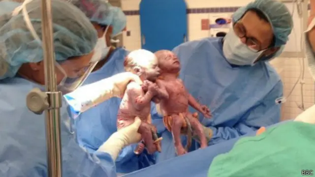 تكرر حالة ولادة التوأمان من مشيمة واحدة وكيس سلوي واحد مرة في الألف. 