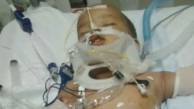 أصيب موسى بكسرين في الذراع ويتنفس بمساعدة جهاز تنفس