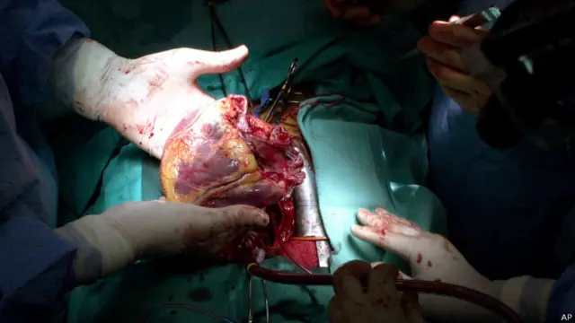 अंग प्रतिरोपण