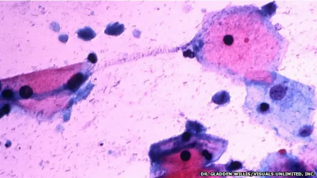 Рак простаты - лабораторные исследования