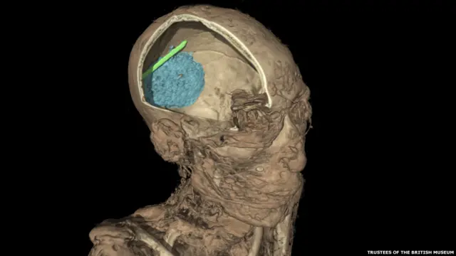 Компьютерная томография останков мумии