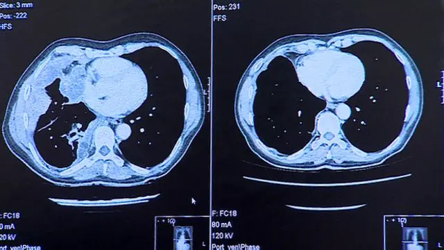 बायीं तस्वीर फेफड़ों तक पहुंचा हुआ मेलानोमा दिखाती है. बड़ा धब्बा ट्यूमर है. दायीं ओर साफ़ दिखता है कि उपचार के बाद ट्यूमर कम हुआ. 