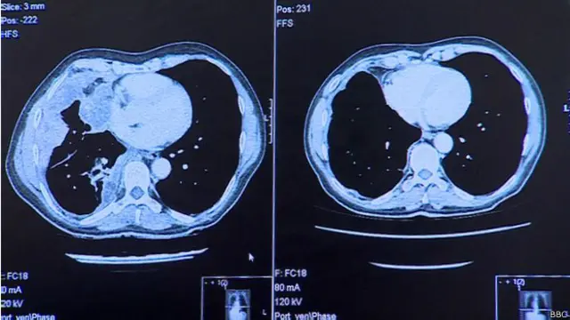 Скан легких