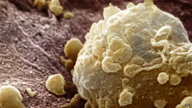 Клетка меланомы