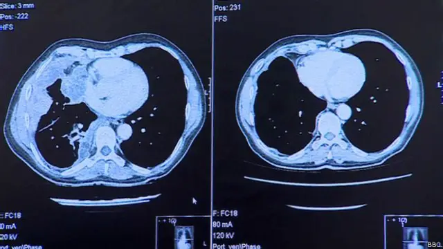 Escaner de pulmón con cáncer