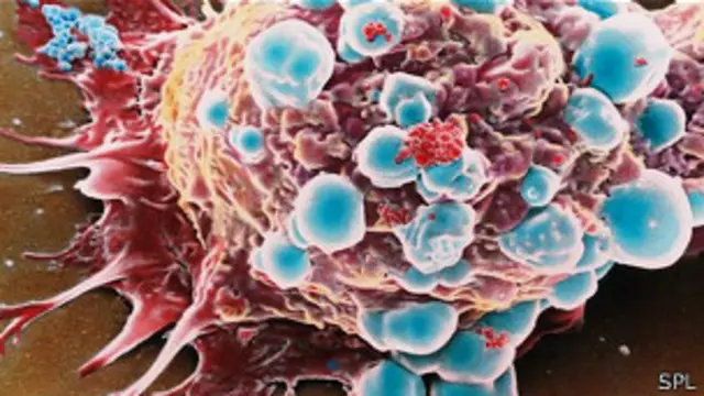 Breast cancer cell