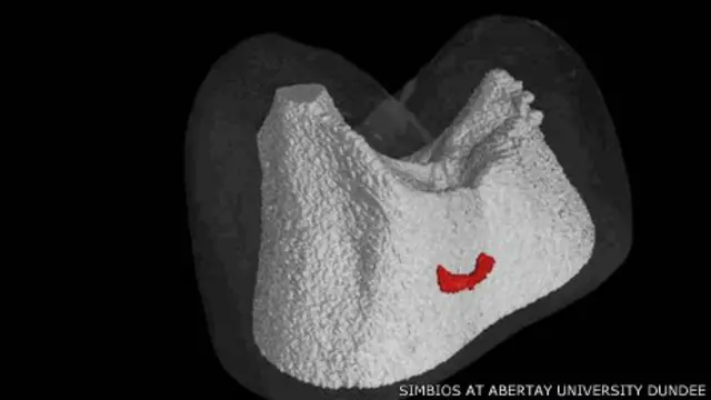 Cárie dentária após o tratamento