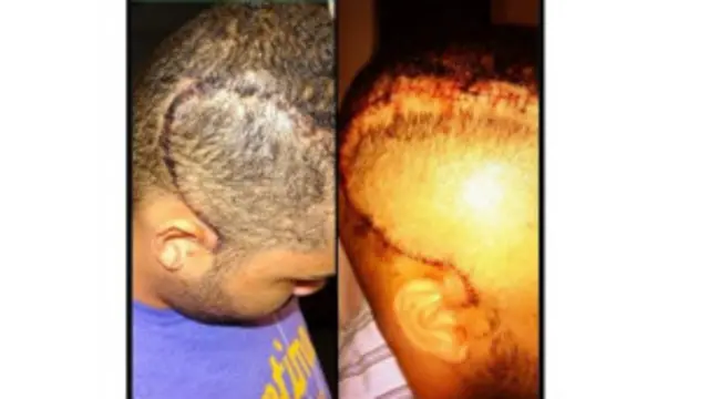 فلوریڈا کے نک بیرٹ نے اپنی تصویر انٹرنیٹ پر ڈالتے ہوئے کہا کہ اگر رونالڈو کے ہیئر سٹائل سے اس بیماری سے متعلق بیداری پیدا ہو تو یہ بڑی بات ہے