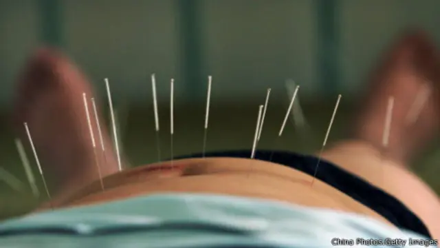 از طب سوزنی در طب نوین برای تسکین درد و بیحسی استفاده میشود