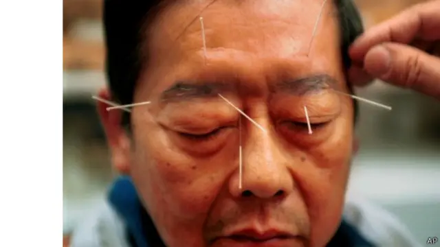 در طب سوزنی، سوزن های بسیار نازکی را در نقاط خاصی از بدن فرو میکنند