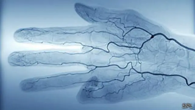 El método incluye sustituir toda la sangre del cuerpo por agra salina fría.