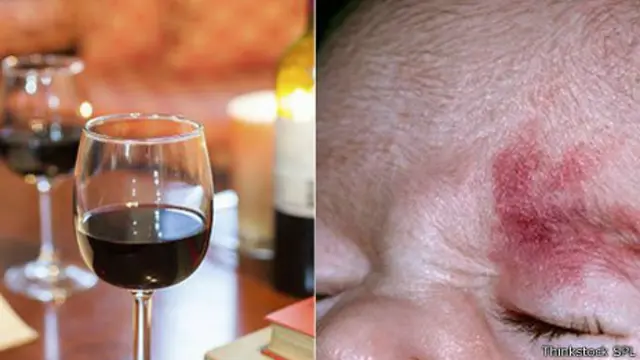 Las manchas de oporto son marcas inofensivas en la cara