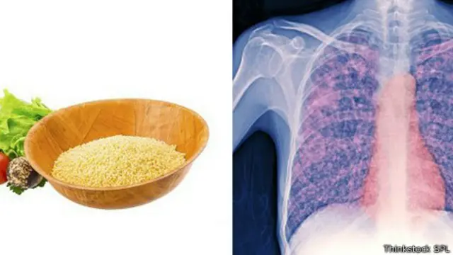 Una radiografía muestra tuberculosis miliar