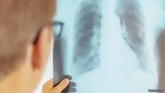 Médico avalia raio x dos pulmões (ThinkStock)