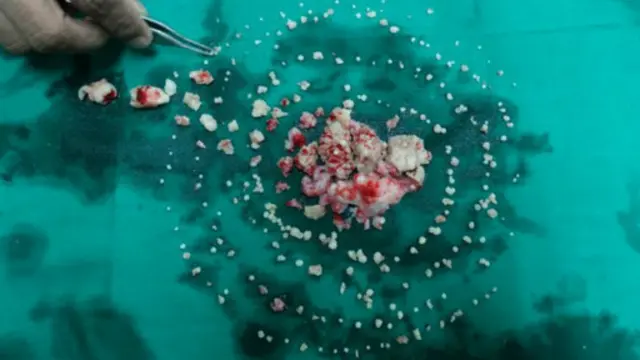 Dentes do indiano Ashik Gavai