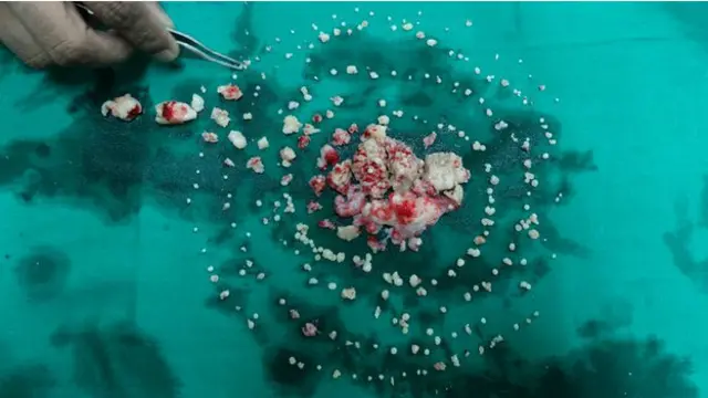 عد الأطباء 232 سنا استخرجت من فم أشيك